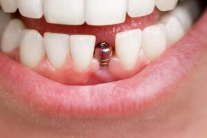 How Long Do Dental Implants Last?