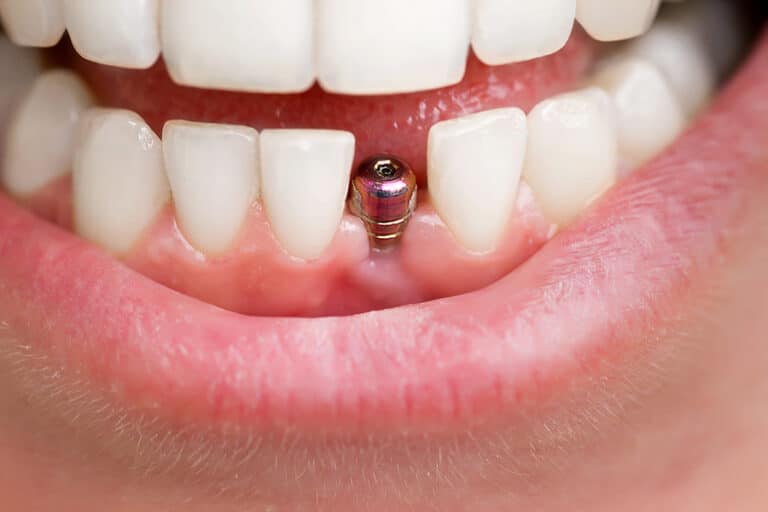 How Long Do Dental Implants Last?