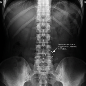 Disc Surgery Explained Simply for Patients