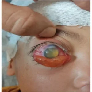 The Benefits of Early Detection of Cysts on the Eye