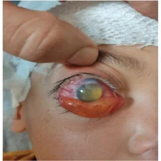 The Benefits of Early Detection of Cysts on the Eye