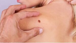 Understanding Skin Cancer in Relation to Mohs Surgery